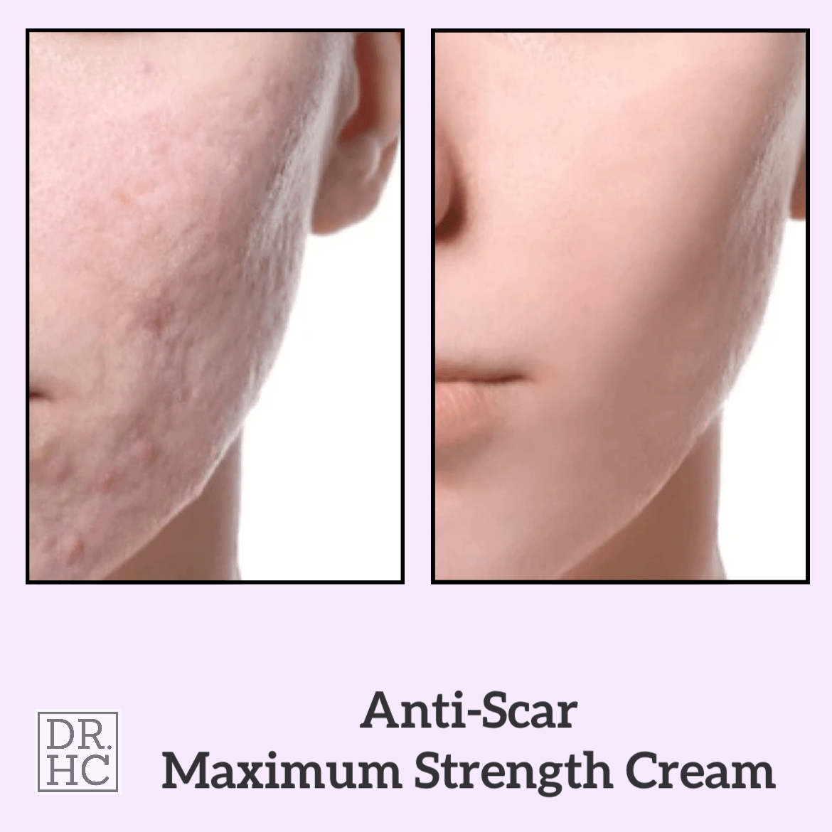 DR.HC Anti-Scar Maximum Strength Cream (10g, 0.35oz.) (Anti-scar, Skin Recovery, Anti-blemish, Anti-inflammatory...)-4