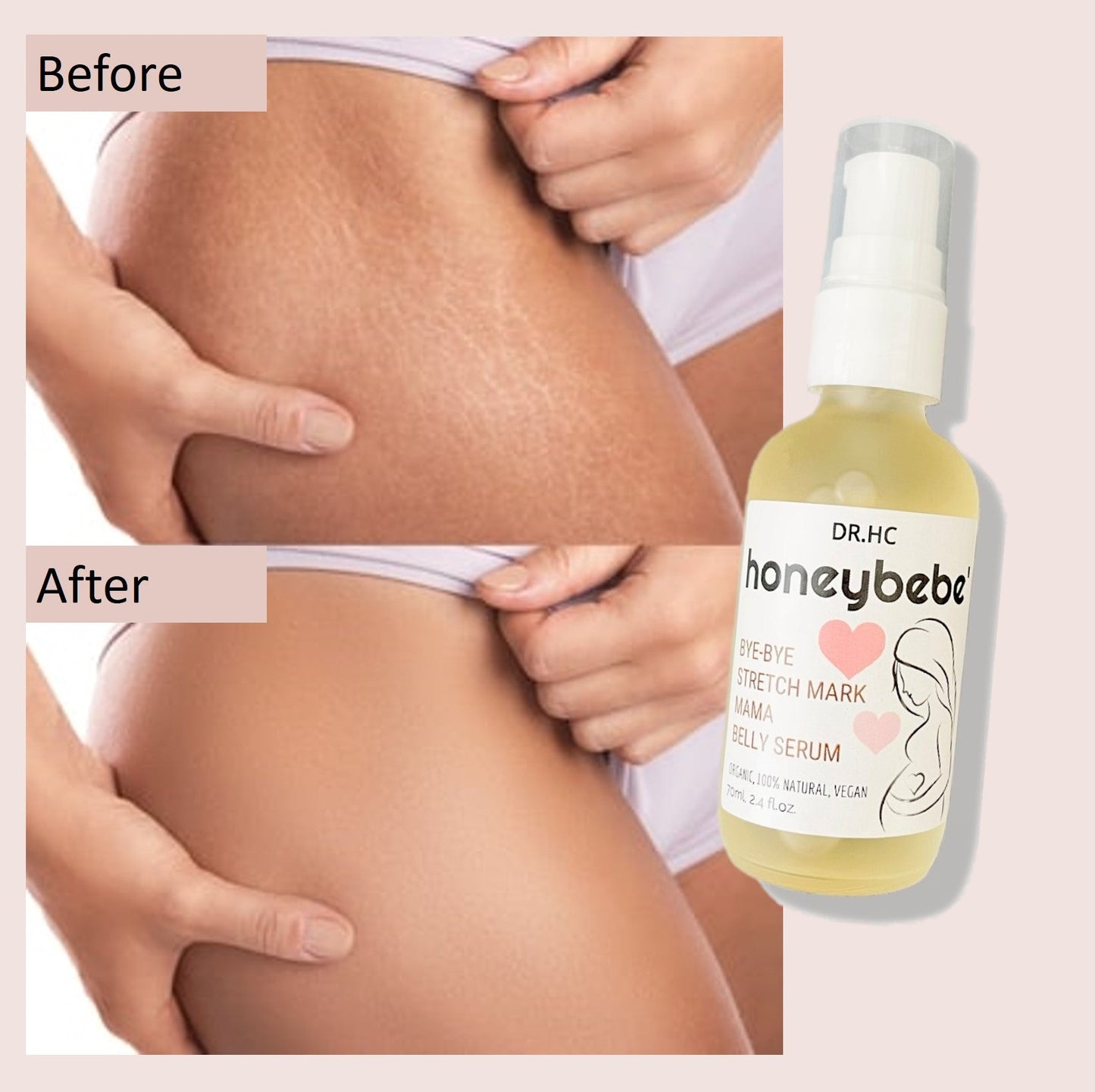 DR.HC Honeybebe' Bye-Bye Stretch Mark Mama Belly Serum (100% Organic, Natural & Vegan) (70ml, 2.4 fl.oz.) (Stretch Mark Prevention & Removal)-3